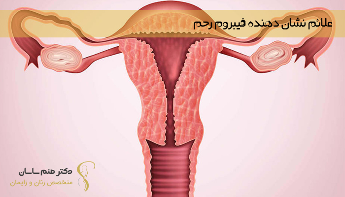 علائم و نشانه های فیبروم رحم 