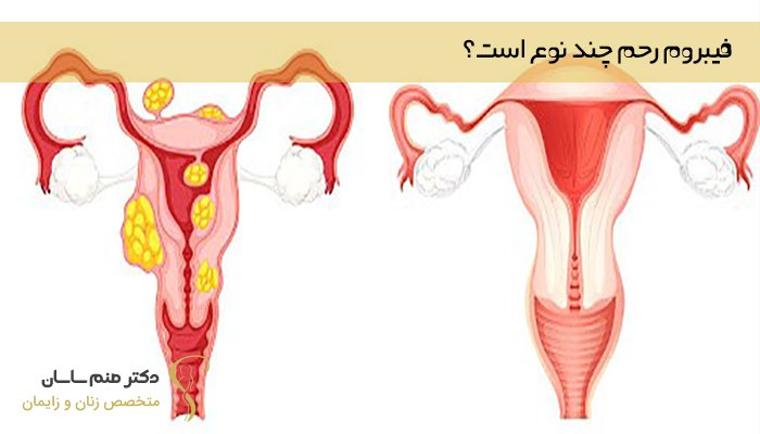 فیبروم رحم چند نوع است؟ 