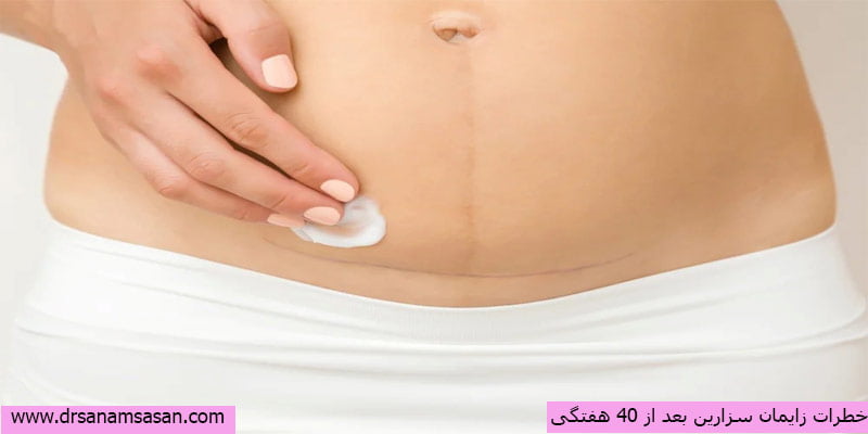 خطرات زایمان سزارین بعد از ۴۰ هفتگی
