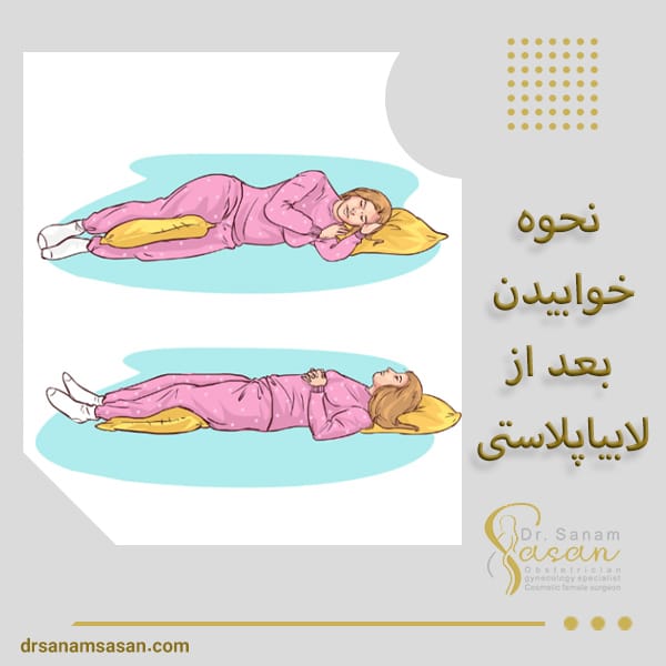 خوابیدن بعد از لابیاپلاستی - دکتر صنم ساسان