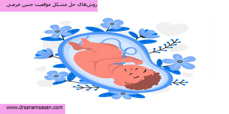 روش‌های حل مشکل موقعیت جنین عرضی
