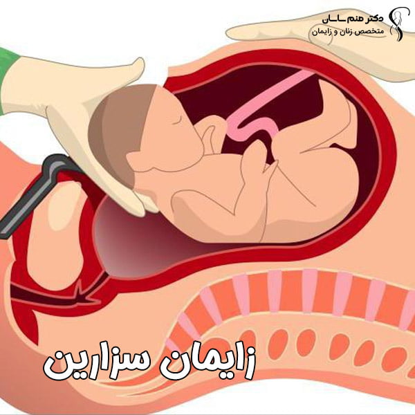 زایمان سزارین - دکتر صنم ساسان 