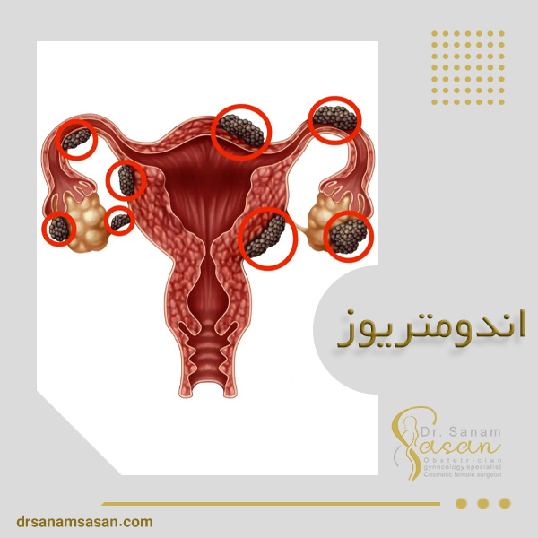 اندومتریوز + دکتر صنم ساسان