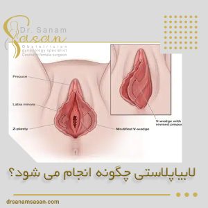 جراحی لابیاپلاستی - دکتر صنم ساسان
