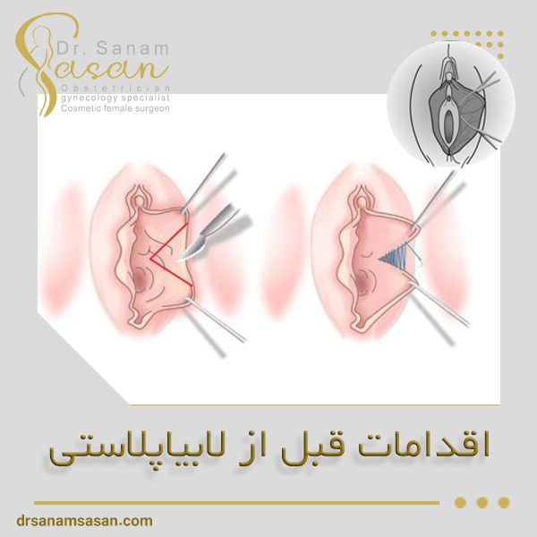 اقدامات قبل از لابیاپلاستی - دکتر صنم ساسان