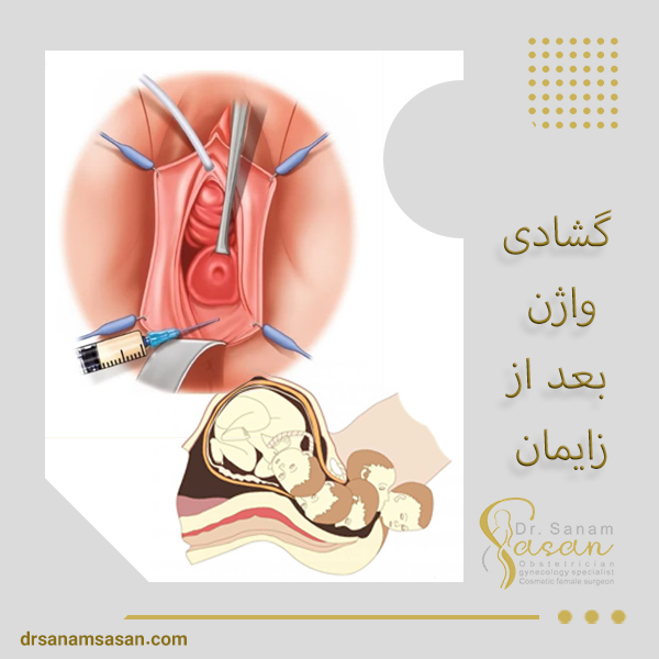 گشادی واژن بعد از زایمان - دکتر صنم ساسان