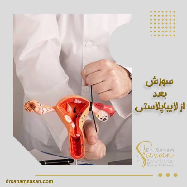 سوزش بعد از لابیاپلاستی