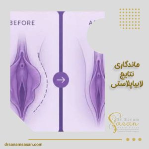 ماندگاری نتیجه لابیاپلاستی