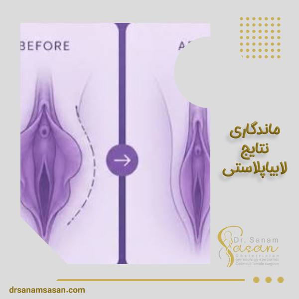 ماندگاری نتیجه لابیاپلاستی