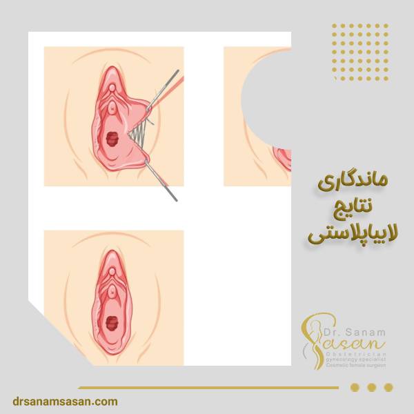 ماندگاری نتیجه لابیاپلاستی