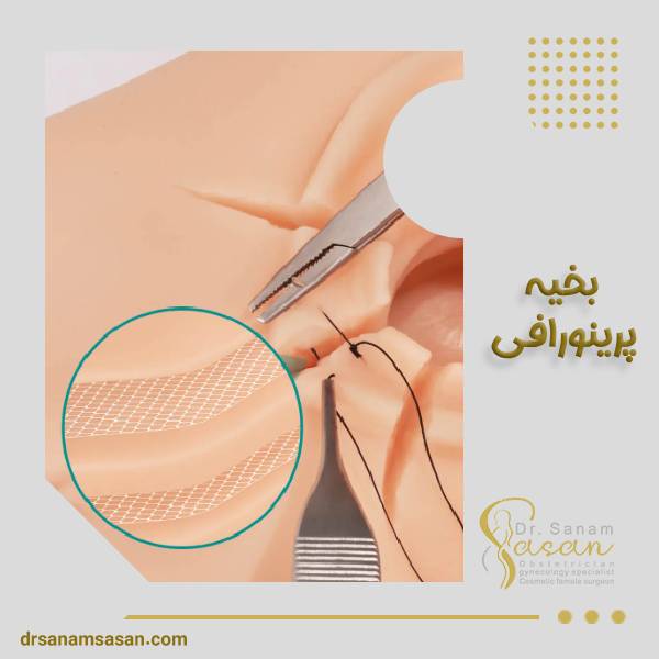 جراحی بخیه پرینورافی
