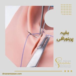 بخیه پرینورافی