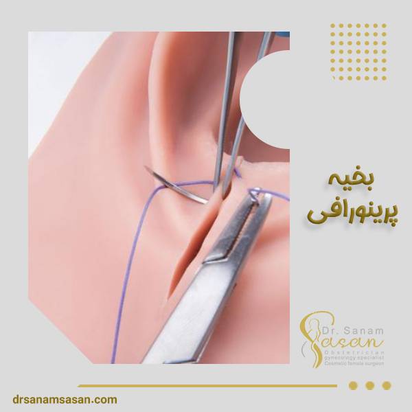 بخیه پرینورافی