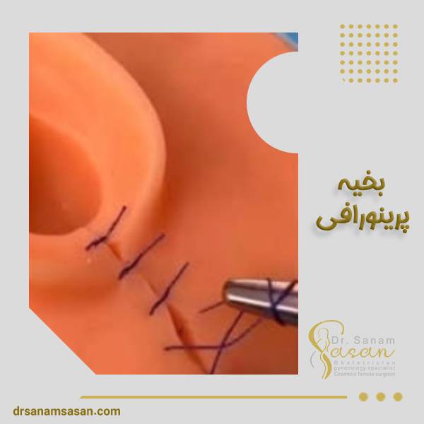 جراحی بخیه پرینورافی